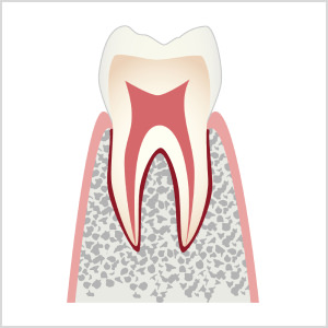 C0：歯に穴は開いておらず、酸によって表面が溶け始めている状態