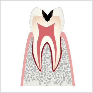 C2：虫歯菌がエナメル質の内部にある象牙質を浸食した状態