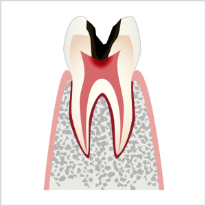 C3：虫歯菌が歯髄（神経）にまで達した状態