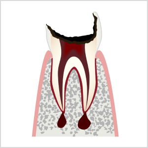 C4：歯の大部分が失われ、歯根まで侵された状態