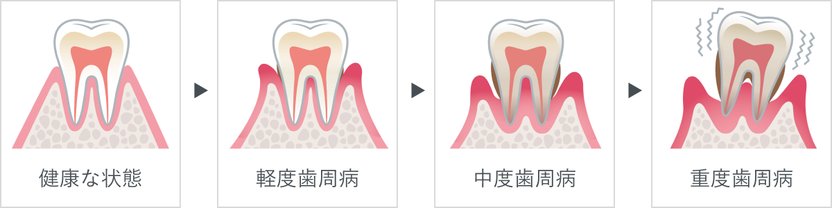 歯周病の進行状況と治療の流れ