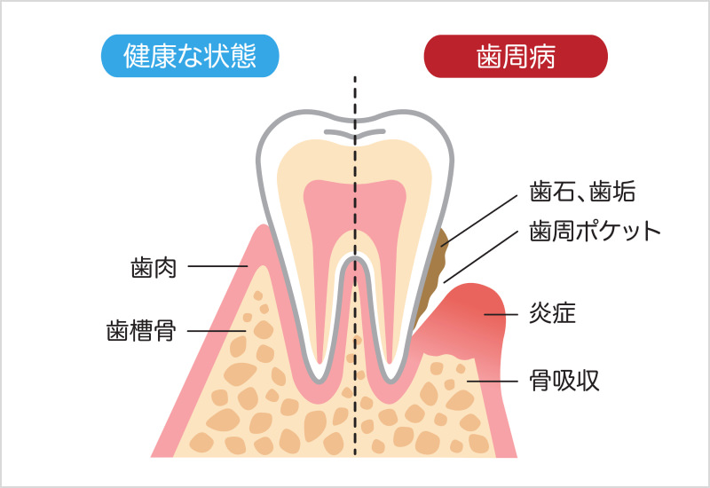 歯周病の原因